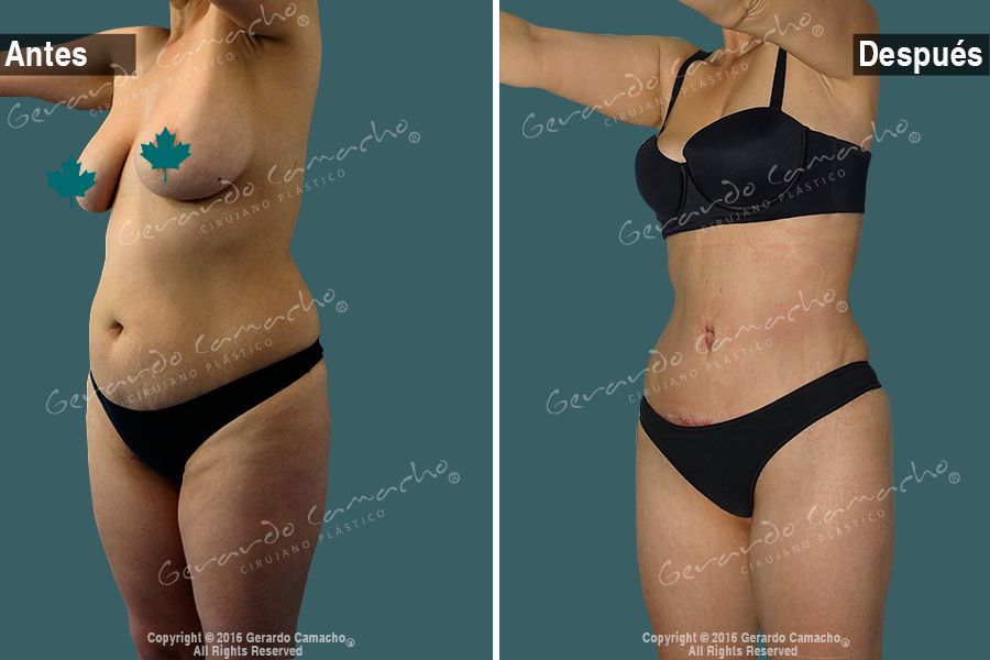 Testimonio Abdominoplastia Colombia